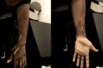 Side-by-side photos of the front and back of a child's hand and arm which shows long, vicious burn scars.