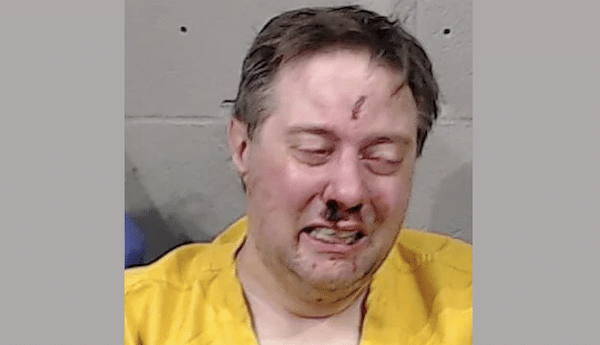 Mugshot of a man in a yellow jumpsuit with visible facial injuries, including swelling and bruises on his nose and forehead, standing against a gray cinderblock wall.