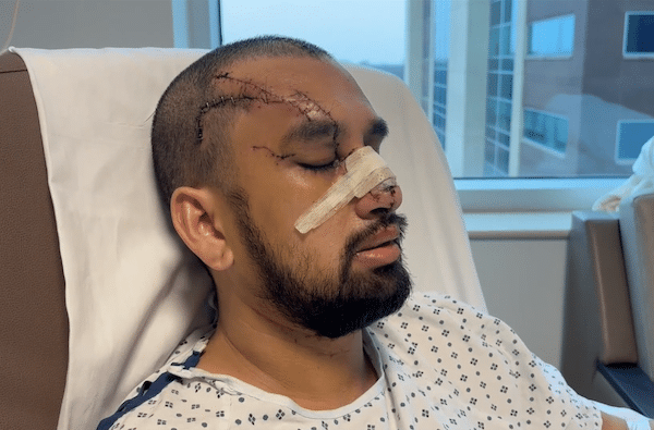 Man in a hospital bed with bandages on his nose and visible stitches along the side of his scalp and near his eye, eyes closed as he rests in a patient gown.